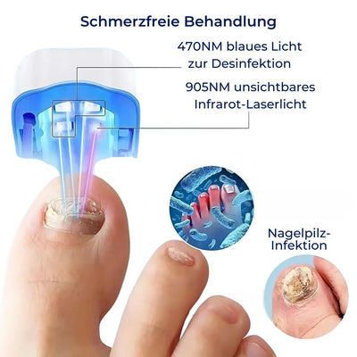 ClearNagel Pro | Nagelpilz-Lasergerät – Nicht-invasiv – Schmerzfreie Behandlung – Entfernt Pilzzellen – Fördert gesunde Nagelregeneration